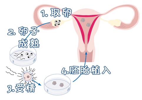 私人高龄代怀助孕服务哪家好试管婴儿中心